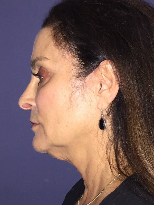 Neck Lift Before & After Gallery - Patient 174003200 - Image 5