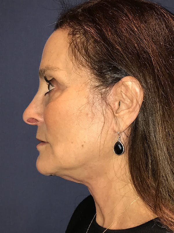 Neck Lift Before & After Gallery - Patient 174003200 - Image 6