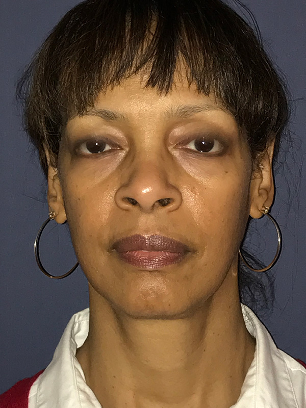 Patient 174003894 | Neck Lift Gallery | Alizadeh Cosmoplastic Surgery