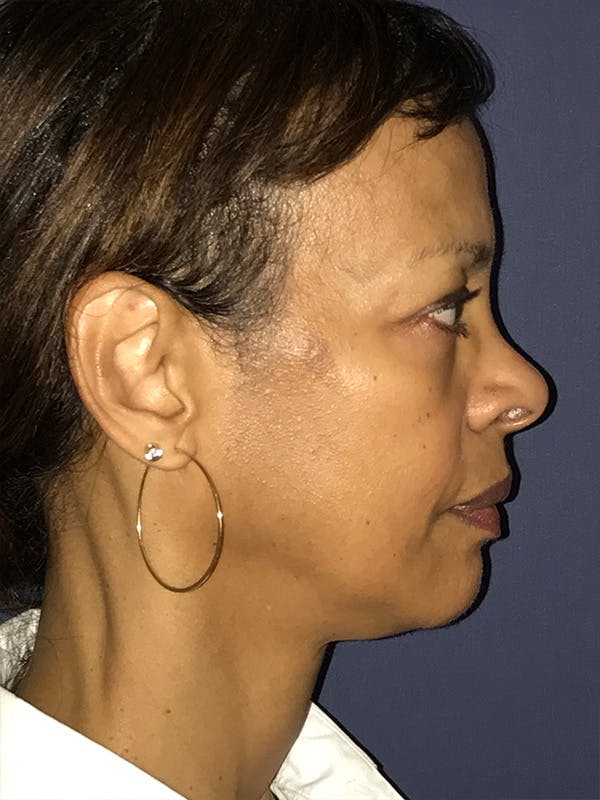 Facelift Before & After Gallery - Patient 174003893 - Image 3