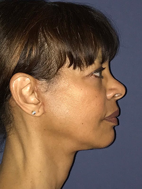 Neck Lift Before & After Gallery - Patient 174003894 - Image 4