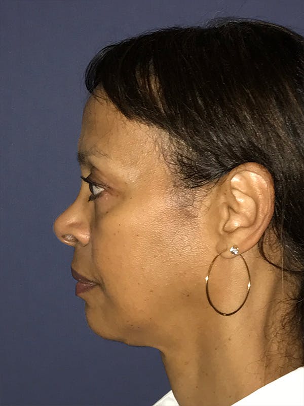 Facelift Before & After Gallery - Patient 174003893 - Image 5