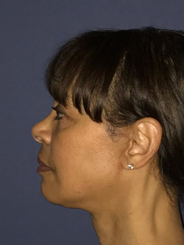 Neck Lift Before & After Gallery - Patient 174003894 - Image 6