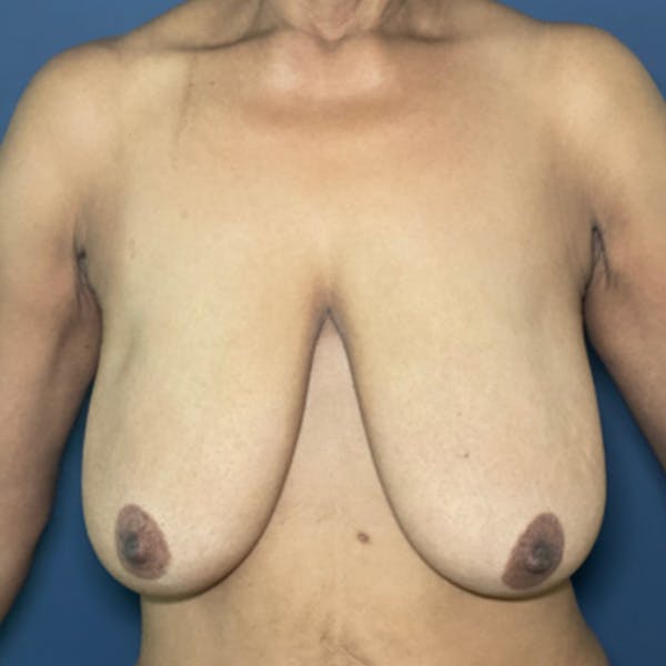NaturaBra® Mastopexy Before & After Gallery - Patient 281753 - Image 1