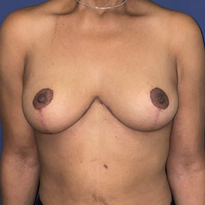 NaturaBra® Mastopexy Before & After Gallery - Patient 281753 - Image 2