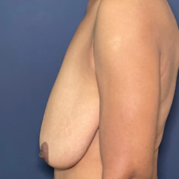 NaturaBra® Mastopexy Before & After Gallery - Patient 281753 - Image 3