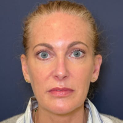Blepharoplasty (Eyelid Surgery) Before & After Gallery - Patient 190117 - Image 2