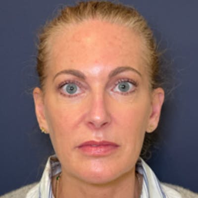 Blepharoplasty (Eyelid Surgery) Before & After Gallery - Patient 190117 - Image 2
