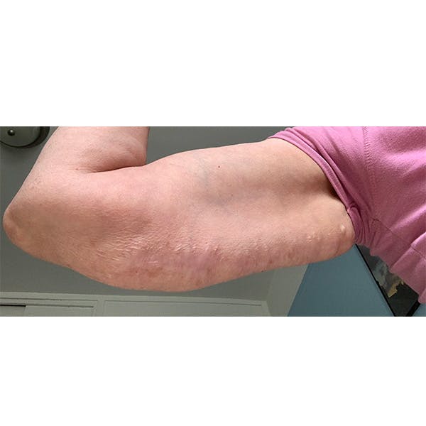 Arm Lift Before & After Gallery - Patient 112132 - Image 1
