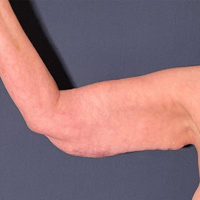 Arm Lift Before & After Gallery - Patient 112132 - Image 1