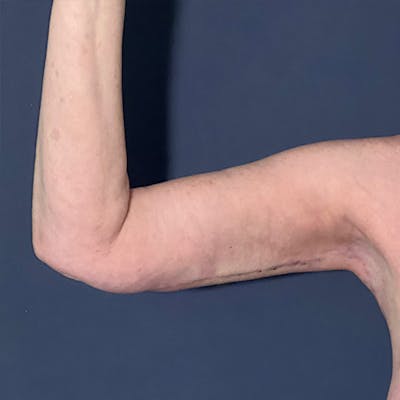 Arm Lift Before & After Gallery - Patient 112132 - Image 4