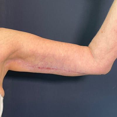 Arm Lift Before & After Gallery - Patient 112132 - Image 6