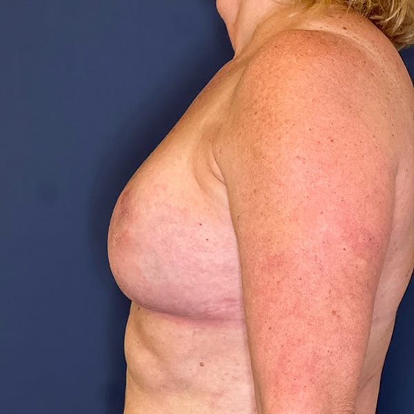 NaturaBra® Mastopexy Before & After Gallery - Patient 160747 - Image 6