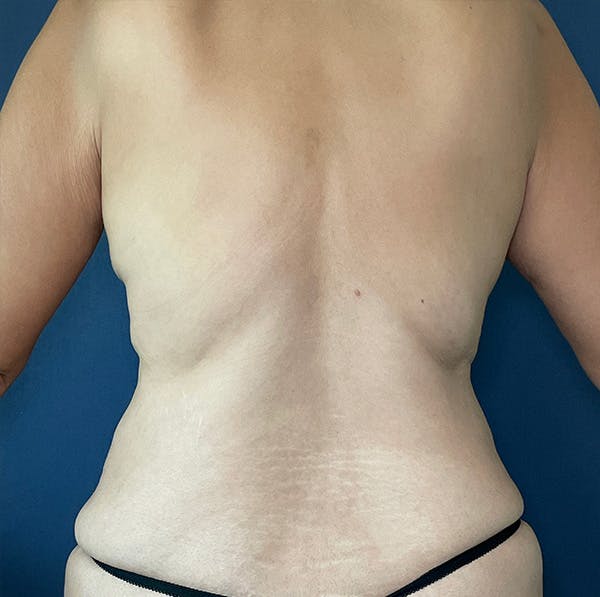 NaturaBra® Mastopexy Before & After Gallery - Patient 161573642 - Image 7