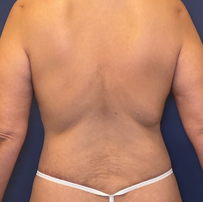 Tummy Tuck (Abdominoplasty) Before & After Gallery - Patient 161573629 - Image 8