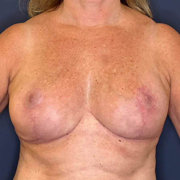 NaturaBra® Mastopexy Before & After Gallery - Patient 160747 - Image 2