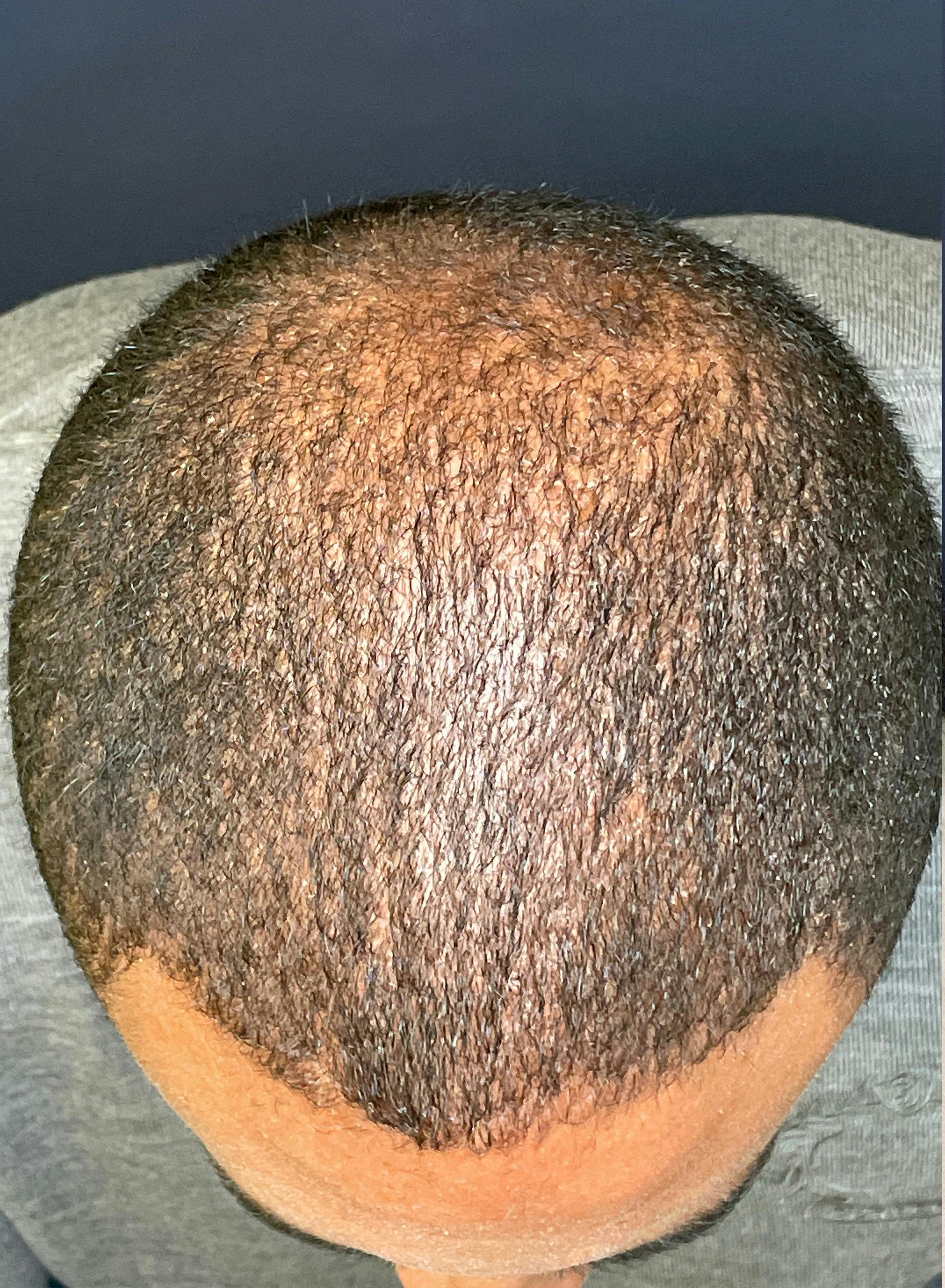 Exosomes/ExoBoost Before & After Gallery - Patient 579386 - Image 2