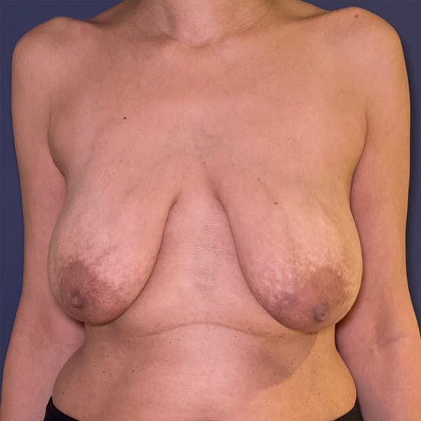 Breast Lift with Fat Grafting Before & After Gallery - Patient 419940 - Image 1
