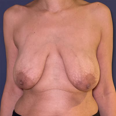 NaturaBra® Mastopexy Before & After Gallery - Patient 169408 - Image 1