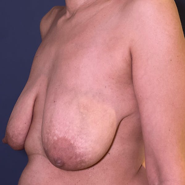Liposuction Before & After Gallery - Patient 110701 - Image 7