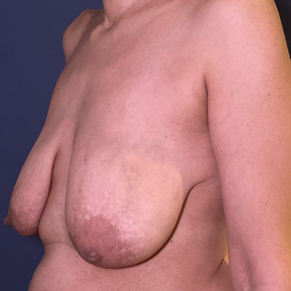NaturaBra® Mastopexy Before & After Gallery - Patient 169408 - Image 7