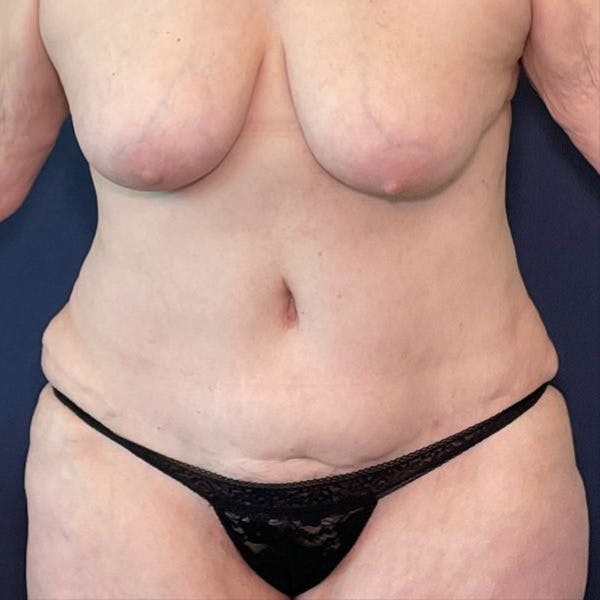 Tummy Tuck (Abdominoplasty) Before & After Gallery - Patient 360160 - Image 1