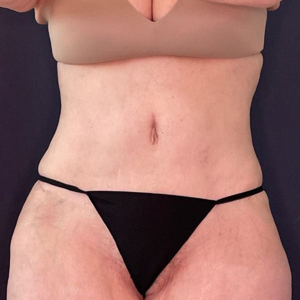 Liposuction Before & After Gallery - Patient 169774 - Image 2