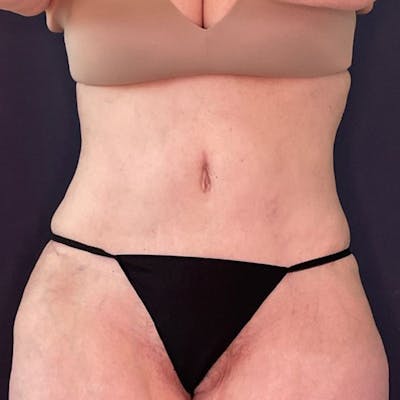 Tummy Tuck (Abdominoplasty) Before & After Gallery - Patient 360160 - Image 2