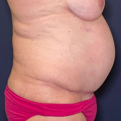 Tummy Tuck (Abdominoplasty) Before & After Gallery - Patient 129321 - Image 1