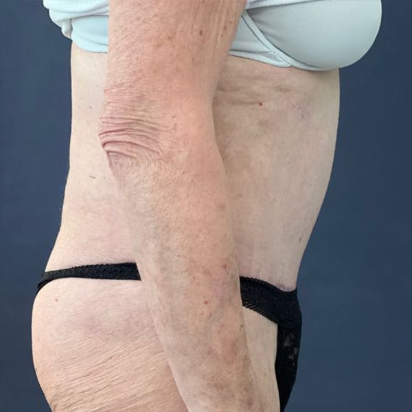 Tummy Tuck (Abdominoplasty) Before & After Gallery - Patient 129321 - Image 2