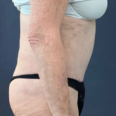 Tummy Tuck (Abdominoplasty) Before & After Gallery - Patient 129321 - Image 2