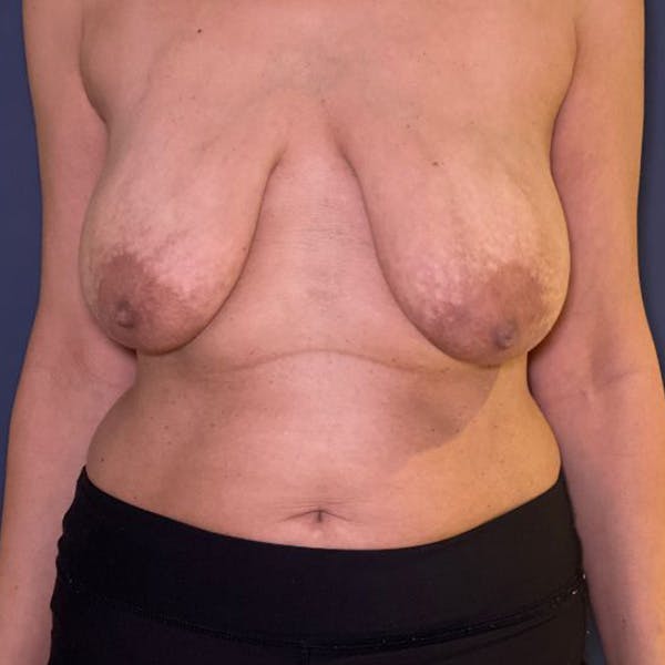 Liposuction Before & After Gallery - Patient 110701 - Image 1