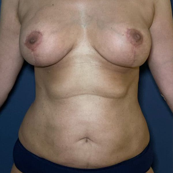 Liposuction Before & After Gallery - Patient 110701 - Image 2