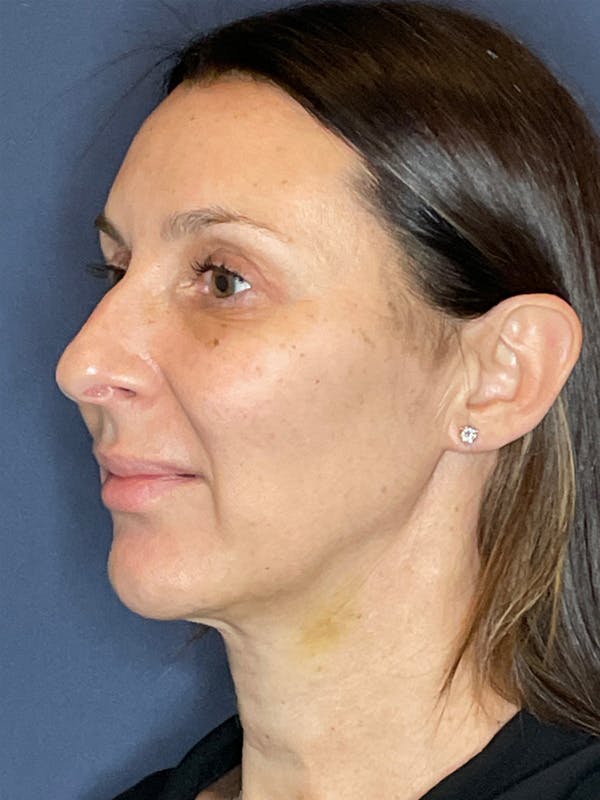 MyEllevate Before & After Gallery - Patient 107218 - Image 2