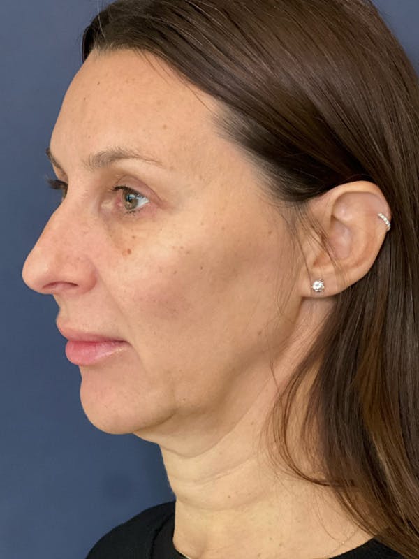 MyEllevate Before & After Gallery - Patient 107218 - Image 1