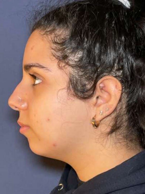 Kybella Before & After Gallery - Patient 351008 - Image 1