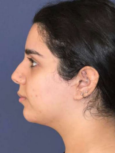 Kybella Before & After Gallery - Patient 351008 - Image 2