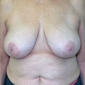 procedure