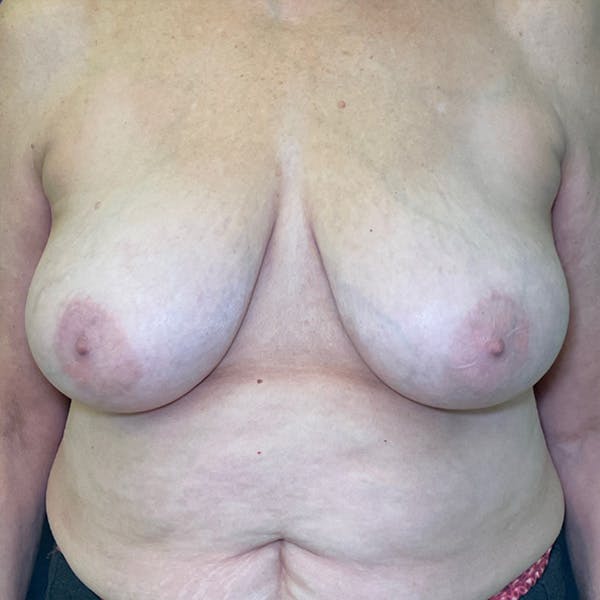 NaturaBra® Mastopexy Before & After Gallery - Patient 193067 - Image 1