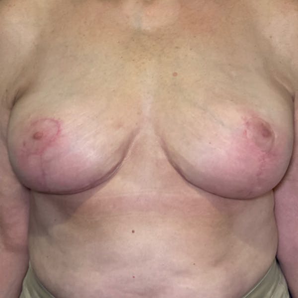 NaturaBra® Mastopexy Before & After Gallery - Patient 193067 - Image 2