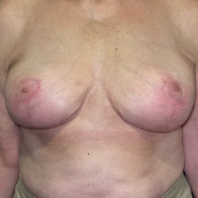 NaturaBra® Mastopexy Before & After Gallery - Patient 193067 - Image 2