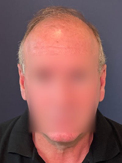 Neograft Before & After Gallery - Patient 111188 - Image 1