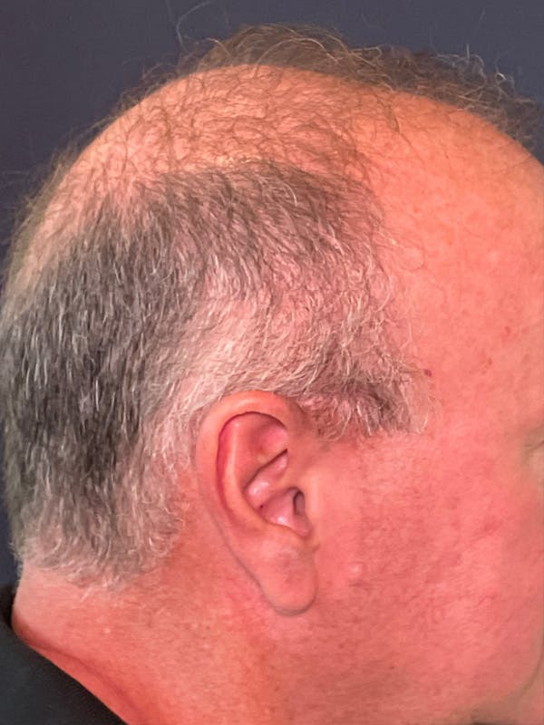 Neograft Before & After Gallery - Patient 111188 - Image 3