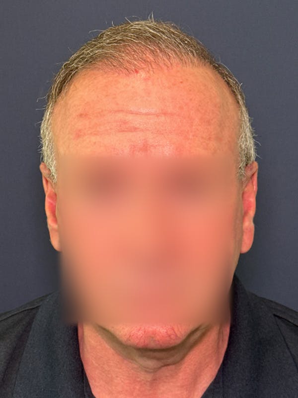 Neograft Before & After Gallery - Patient 111188 - Image 2
