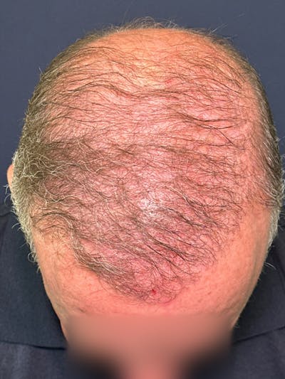 Neograft Before & After Gallery - Patient 111188 - Image 6