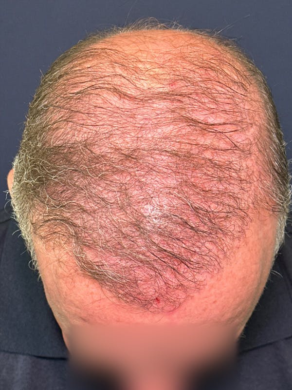 Neograft Before & After Gallery - Patient 111188 - Image 6