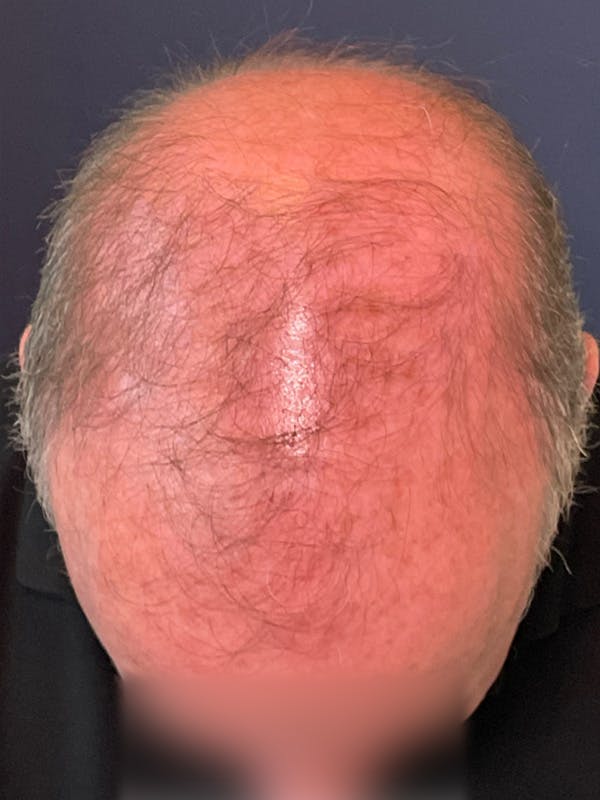 Neograft Before & After Gallery - Patient 111188 - Image 5