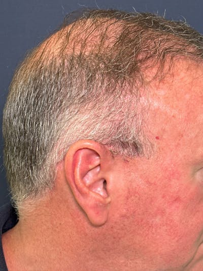Neograft Before & After Gallery - Patient 111188 - Image 4
