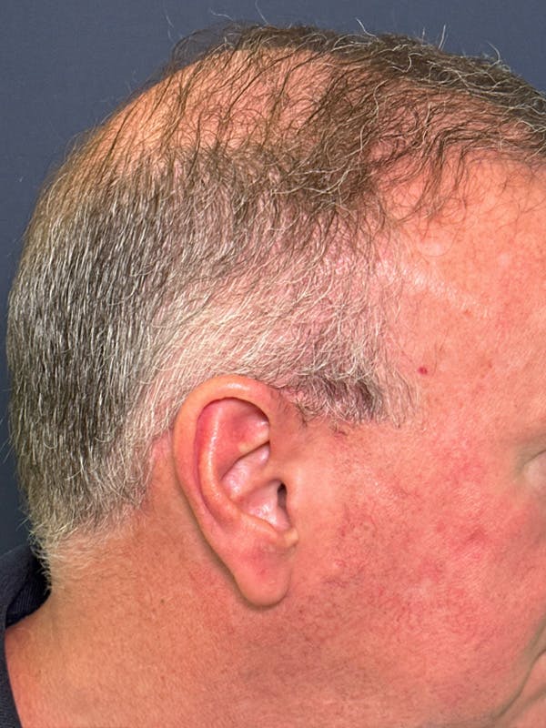 Neograft Before & After Gallery - Patient 111188 - Image 4