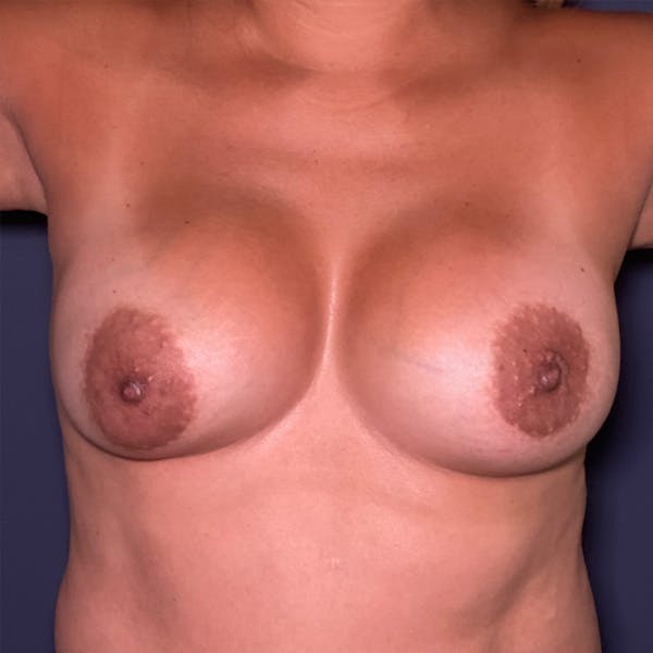 NaturaBra® Mastopexy Before & After Gallery - Patient 107930 - Image 1